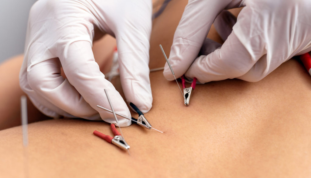 Stock,Photo,Of,Anonymous,Person,With,Gloves,Having,Acupuncture,Treatment