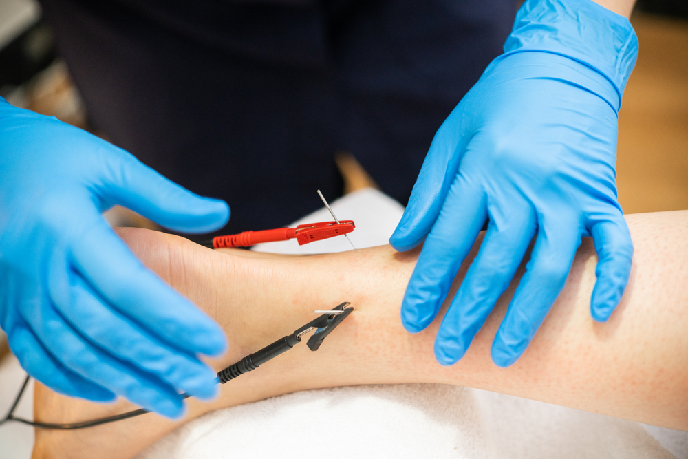 Electro-acupuncture,Dry,With,Needle,Connecting,Machine.,Electro,Stimulation,In,Physical